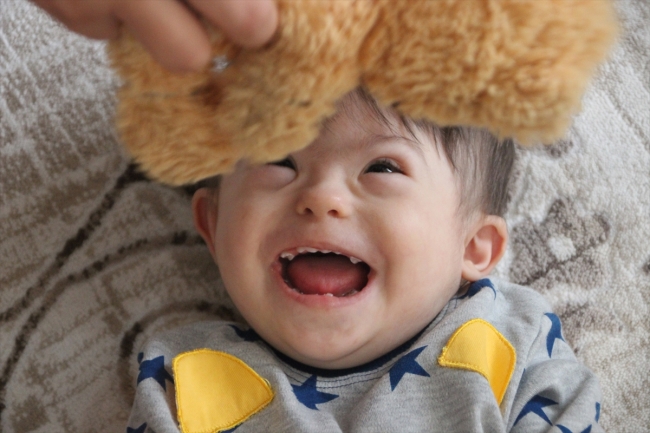 Down sendromlu Mert bebek duyabilmek için yardım bekliyor